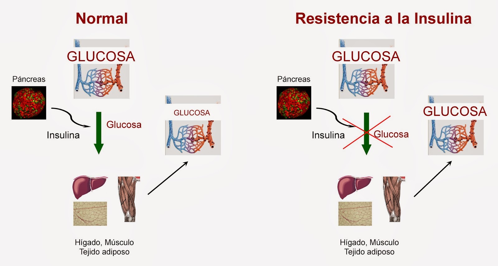 Como mejorar la resistencia a la insulina