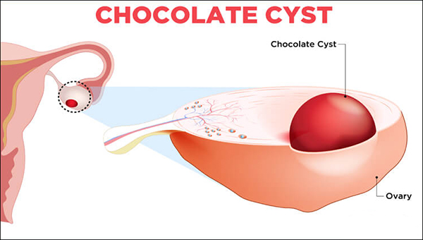 chocolate cyst