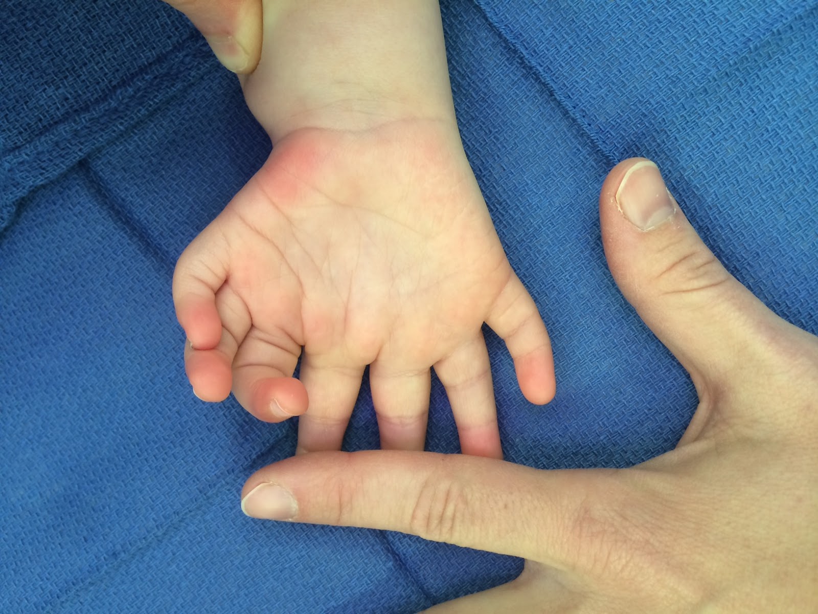 Rebuilding the Mirror Hand Congenital Hand and Arm Differences