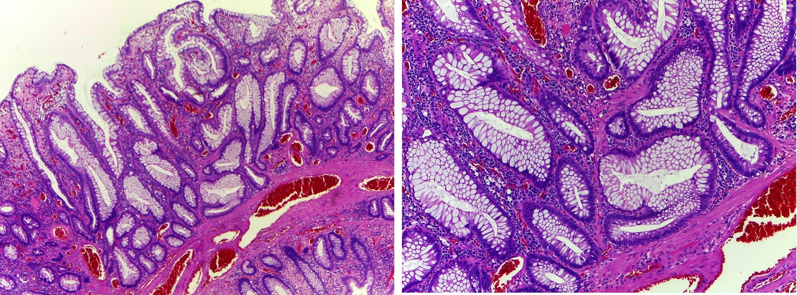 Arborizing Polyps GASTROINTESTINAL AND LIVER HISTOLOGY PATHOLOGY ATLAS: COLON ...