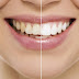 Clareamento pode deixar os dentes de 2 a 3 tons mais claros