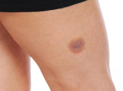 Γιατί κάνετε μελανιές «χωρίς λόγο» – Όλα τα πιθανά αίτια!  