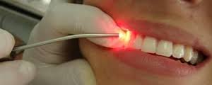Aplicações do Laser na Odontologia