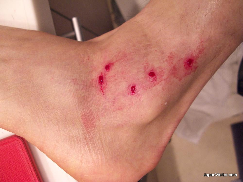 leech bites leech bites