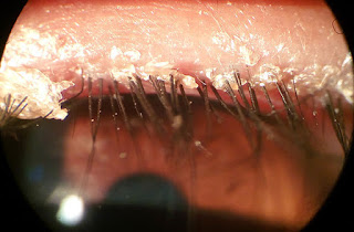 demodex folliculorum en ojo