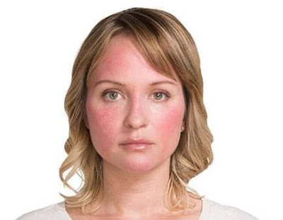 Red face Red Face
