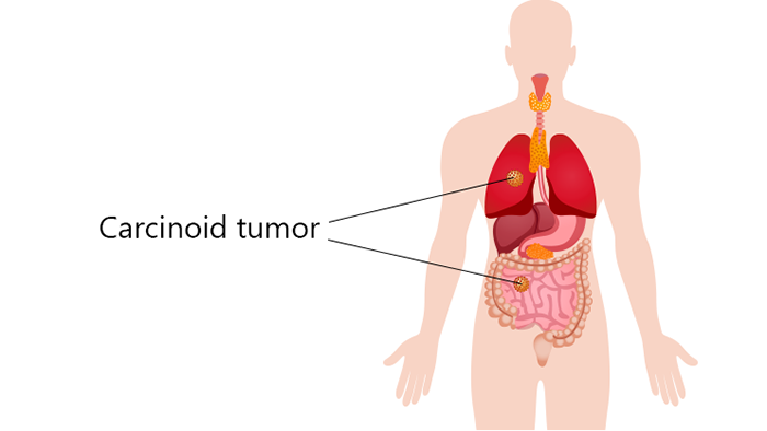 carcinoid tumor, symptoms of carcinoid tumor, ayurvedic treatment for carcinoid tumor, causes of carcinoid tumor, neuroendocrine tumors, digestive tract, lungs, gastrointestinal carcinoid tumors