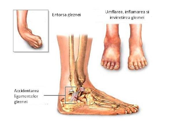 Artroza posttraumatică a umărului și a genunchiului. Artrita prognosticului articulației cotului