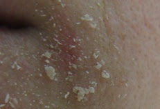 すっぴん力 角質培養を初めて１週間経過 口の周りの乾燥が酷過ぎる