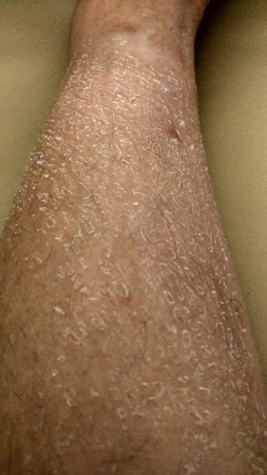 Coping With Ichthyosis 26112017 Skin Shedding Day shedding-or-breakage-how-to-tell-the-difference-fix-it-natural