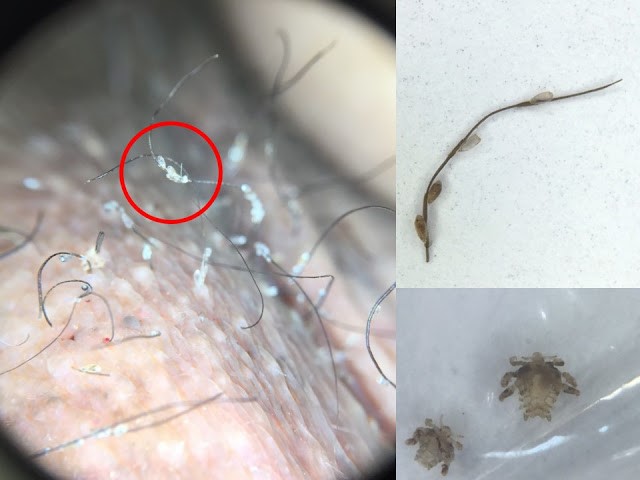 皮膚鏡觀察陰蝨