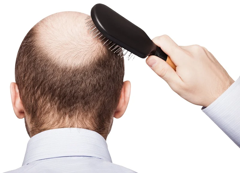 9 maneiras eficazes para parar a queda de cabelo em homens