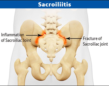 bilateral sacroilitis
