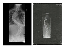 My scoliosis xrays before and after surgery