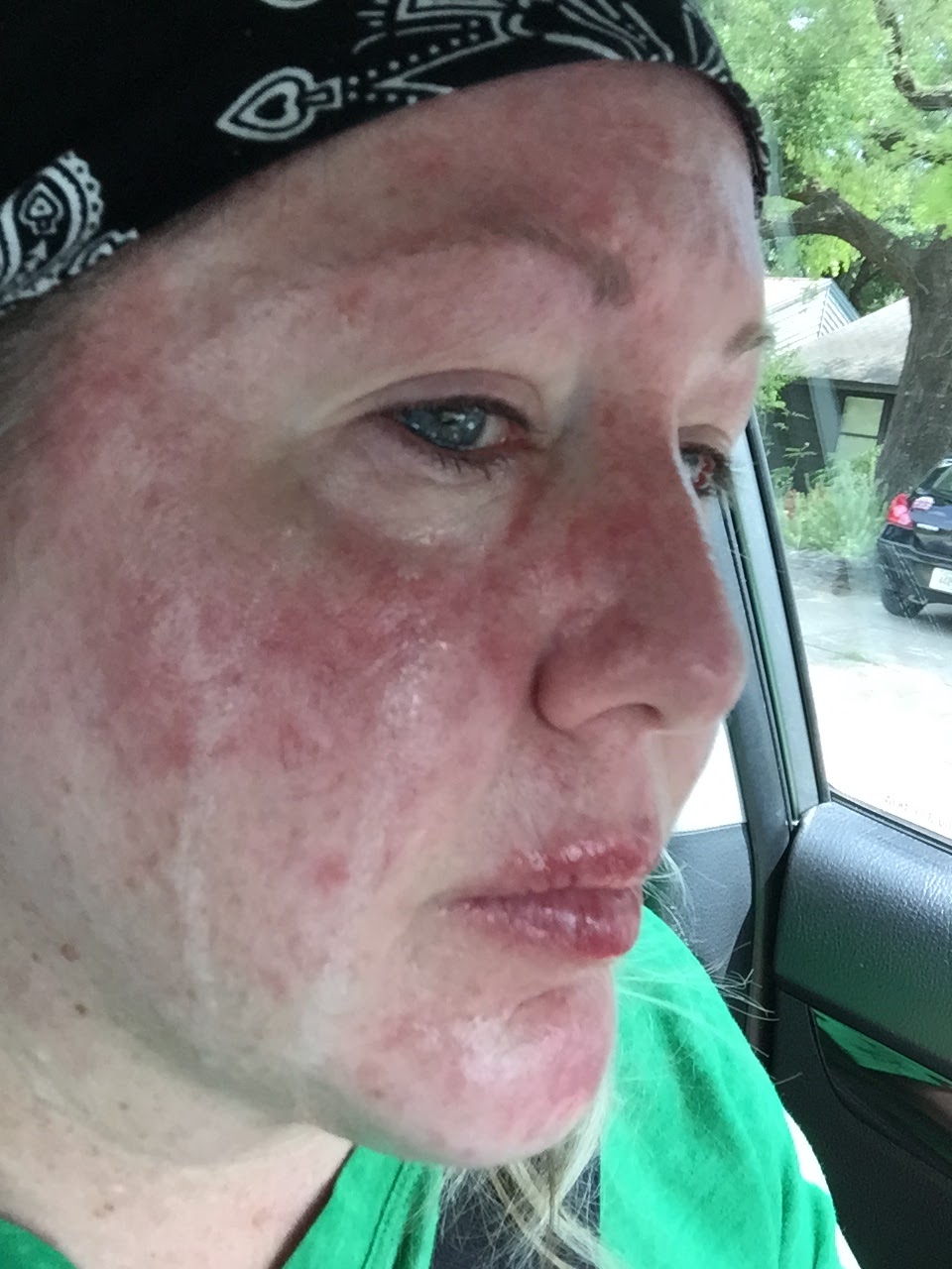 My Journey Through Topical Chemotherapy Fluorouracil 5 Cream and