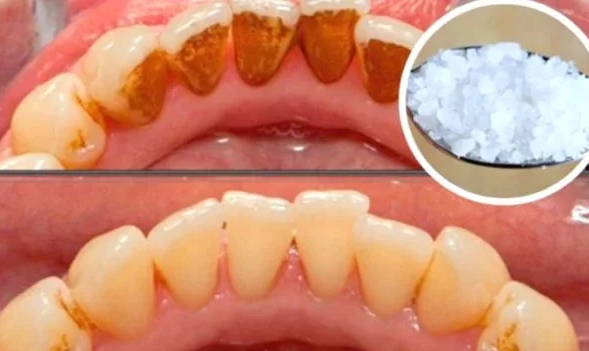 Here's How To Whiten Yellow Teeth