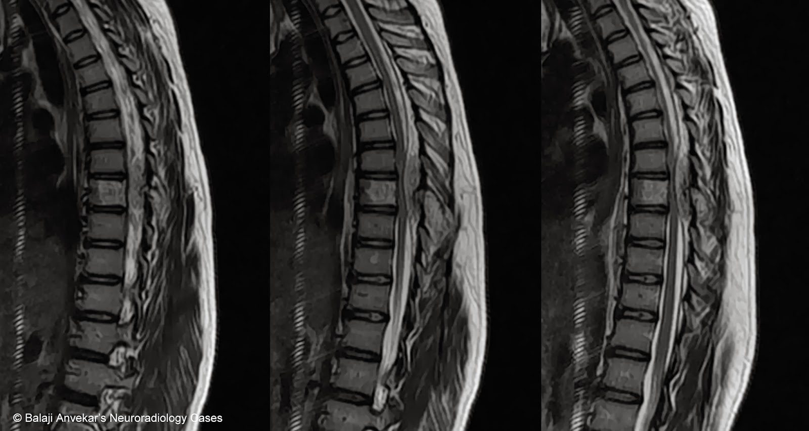 The Spine Hemangioma Of The Spine