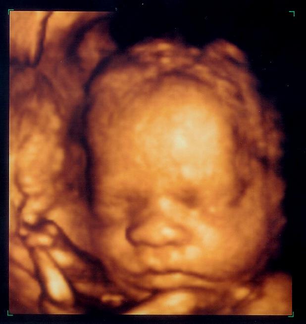 Ultrasound Pictures 116