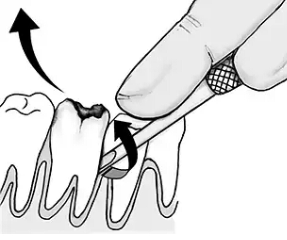 MECHANICAL PRINCIPLE IN TOOTH EXTRACTION