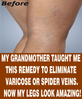 Pin On Varicose Veins