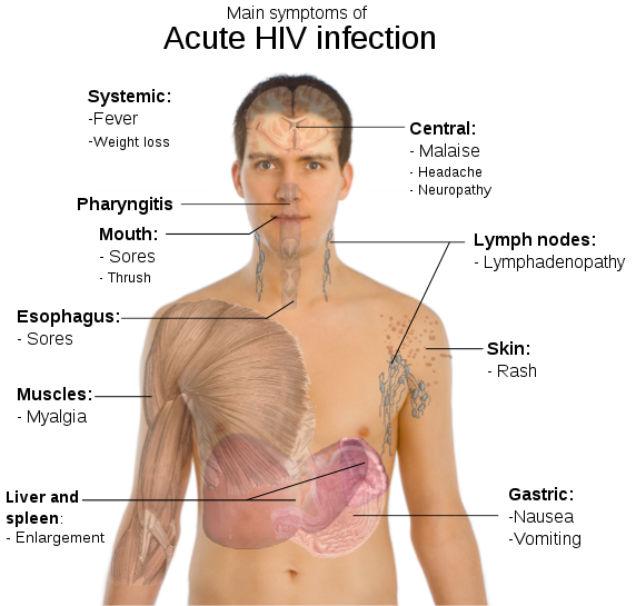 HIDUP MESTI DITERUSKAN: AIDS - FAKTA MENGENAI PENYAKIT