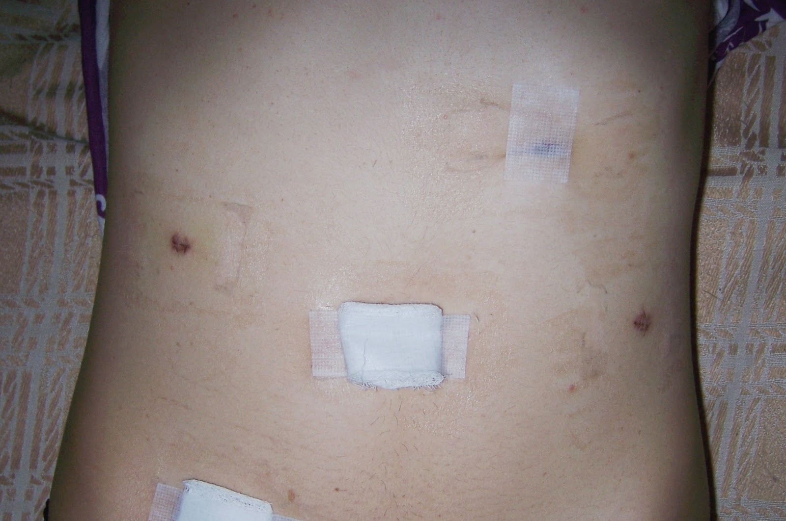 Oncologia, Acne e Rinoplastia: Pós-operatório - Câncer Intestinal