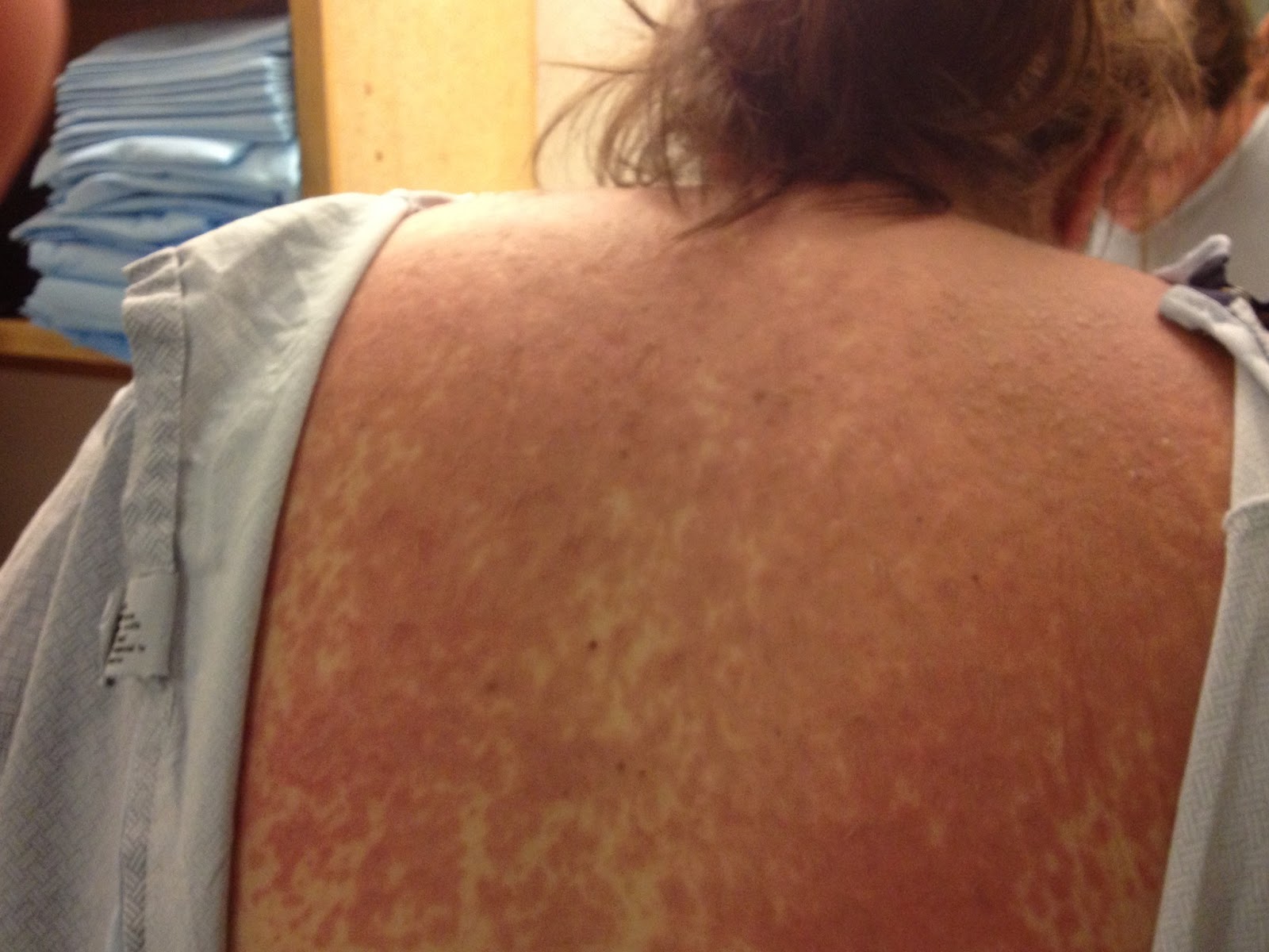 Fighting Stevens Johnson Syndrome : 06/20/13