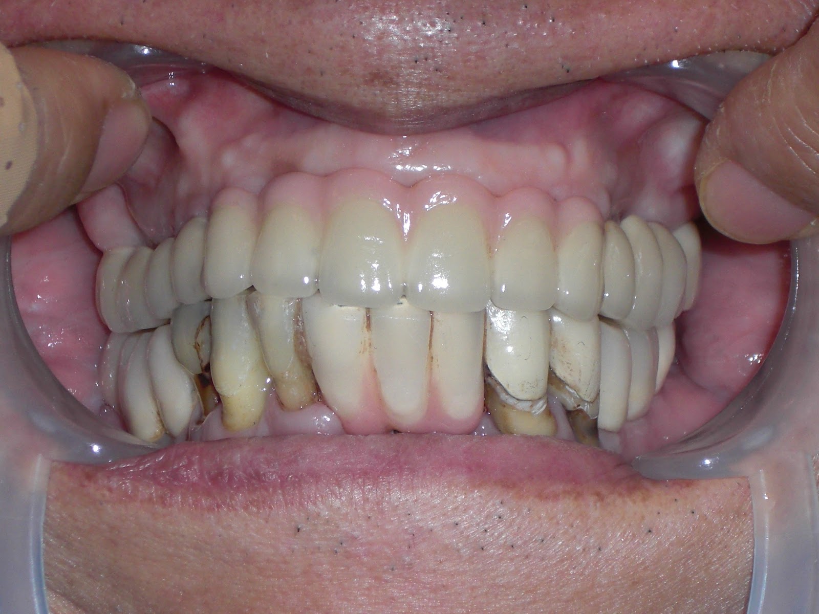 Dental Implantology: THE RESCUE OF A DENTAL CRIPPLE AND A LIFE TRANSFORMED