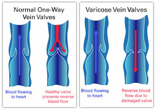 Explanation of varicose veins as well as effective treatments