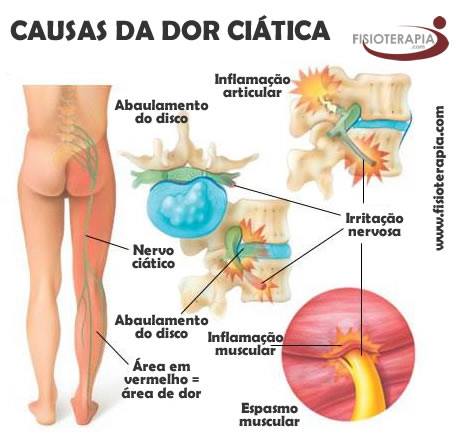 Das pernas frente da para a costas das dor inferior parte