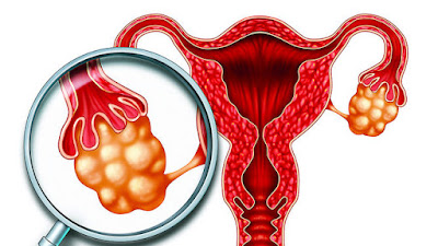 10 Mitos de los Quistes de Ovario