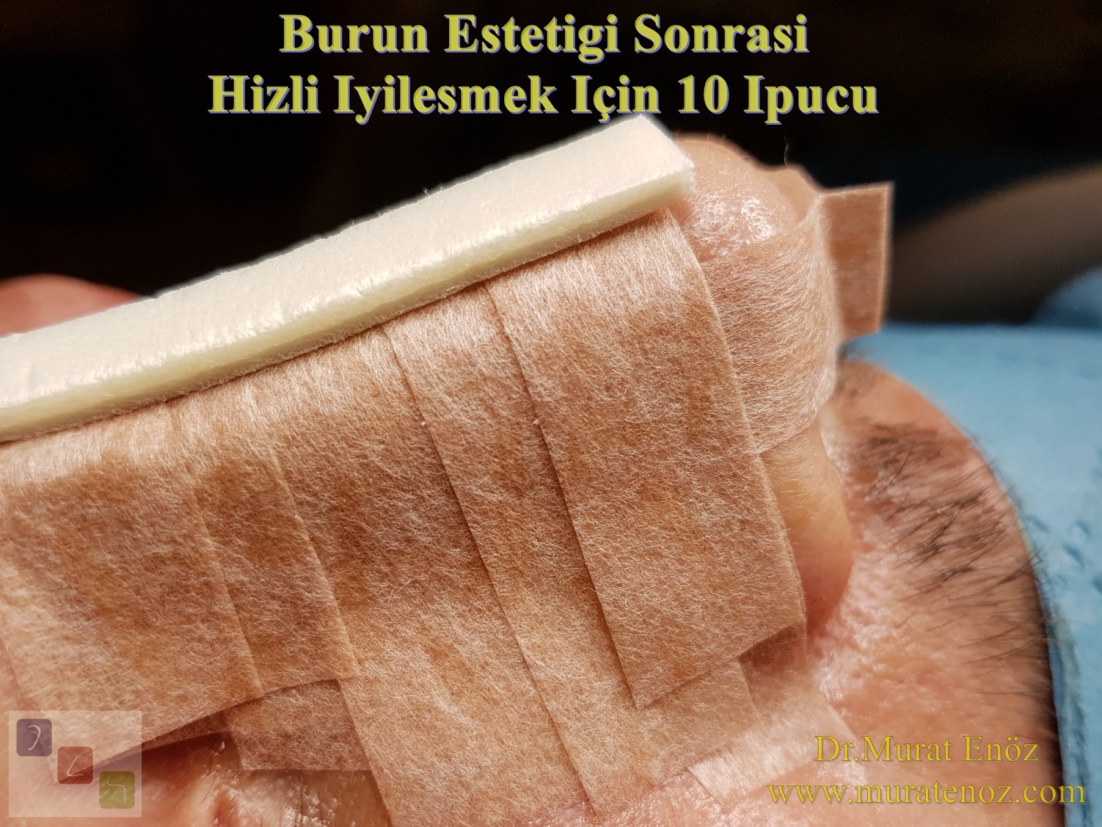 Burun Estetiği Ameliyatından Sonra Hızlı İyileşmek İçin 10 İpucu