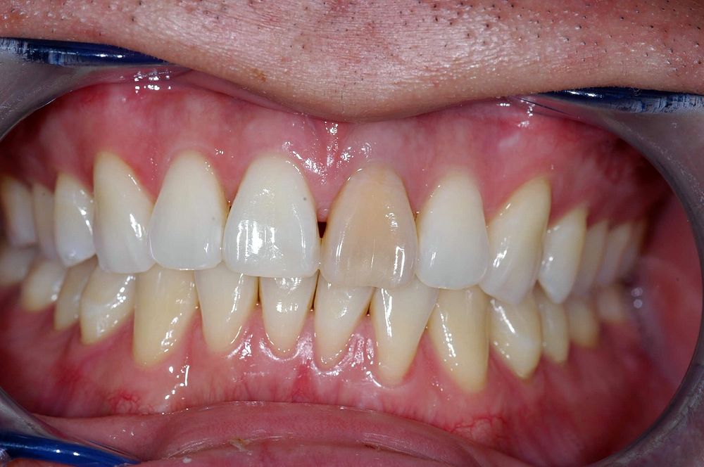 what-causes-permanent-yellowish-discoloration-on-teeth