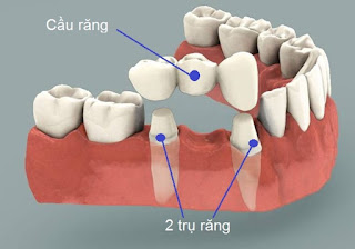 Bị mất răng lâu năm phải làm sao?