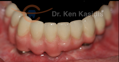 dental%2Bimplant%2Bpattaya%2B003%2BPM