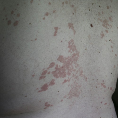 What Is Skin Rashes On Back? SKIN 4 CARES