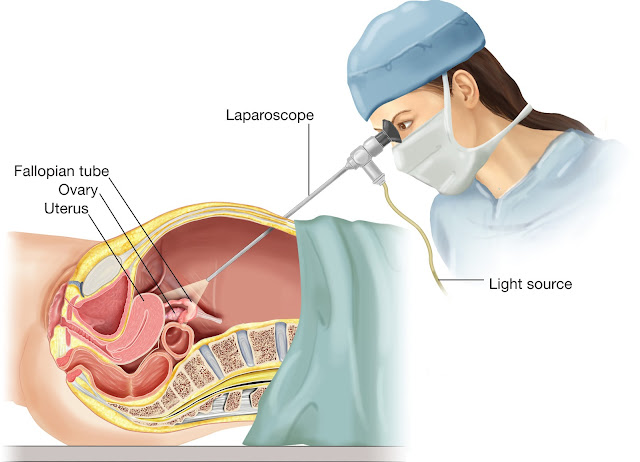 http://www.punyahospitals.com/gynec-laparoscopy-surgery/