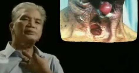 obat herbal utk kanker tenggorokan obat herbal utk kanker tenggorokan