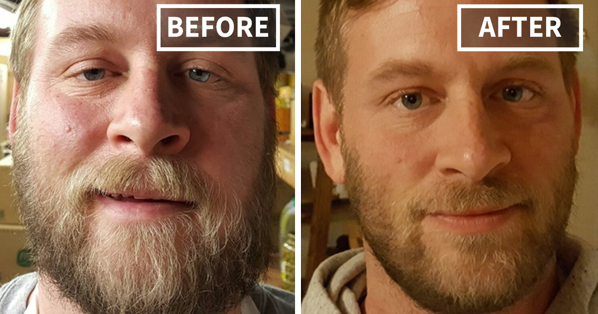 10+ Before-And-After Pics Show What Happens When You Stop Drinking