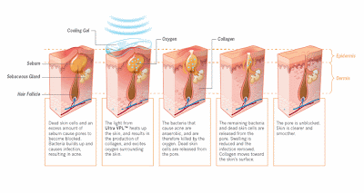 Acne Bacteria: Acne Bacteria: Does It Really Cause Acne?