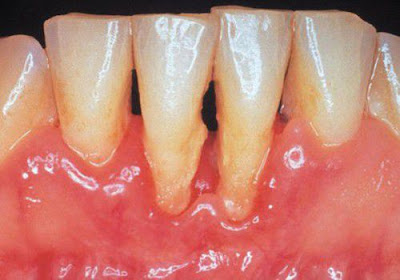 Cạo vôi răng mất bao lâu thời gian?