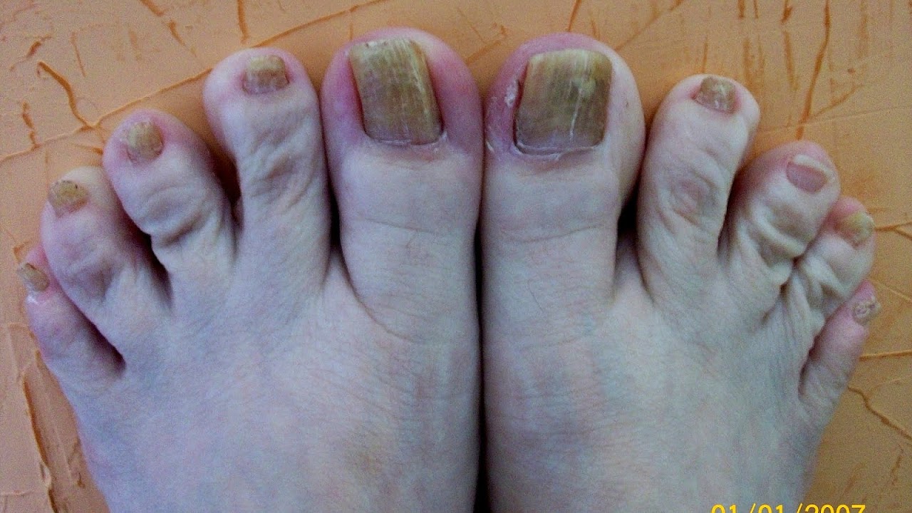Treatment For Thick Yellow Toenails Yellow Choices