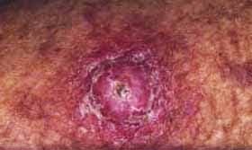 gambar kanker kulit
