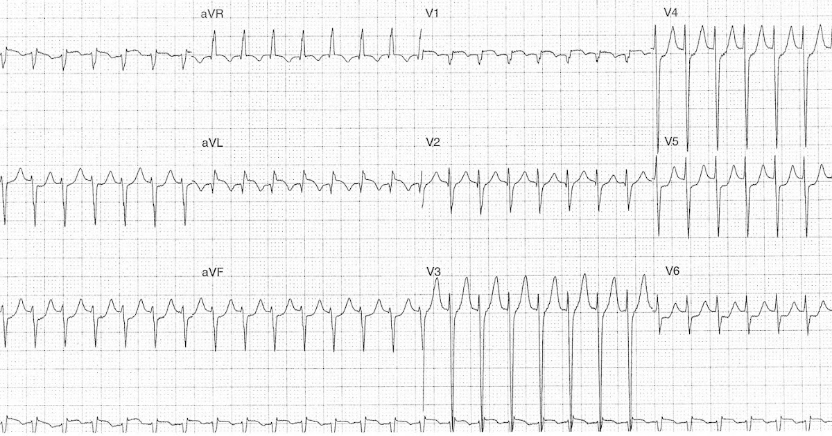ECG of the Week: ECG of the Week - 17th August 2015 - Interpretation