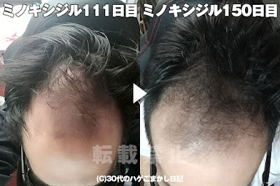 ミノキシジル150日目