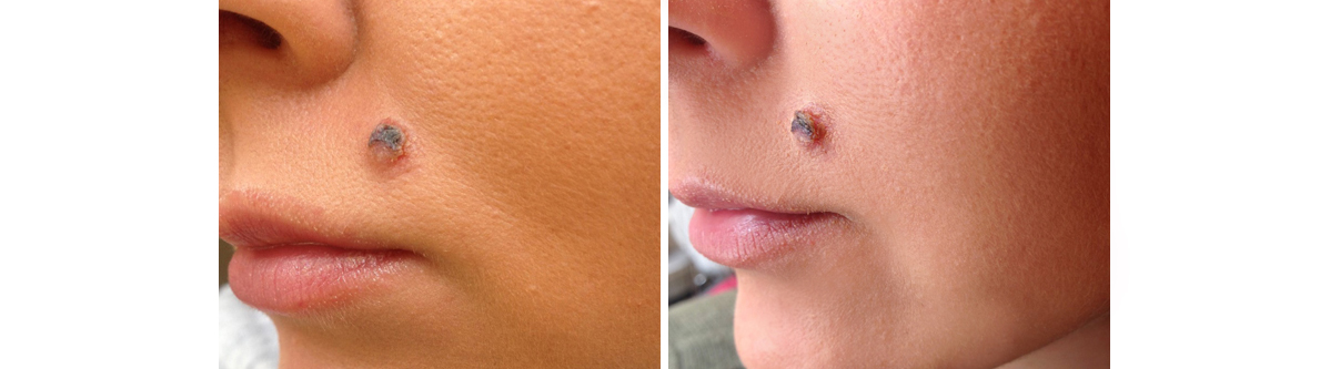 mole cider apple remove vinegar scab dry acv
