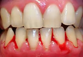 chảy máu chân răng thường xuyên-3