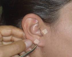 Auriculoterapia para adelgazar antes y despues