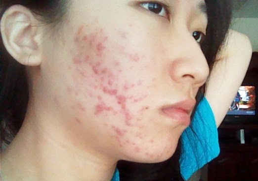 perawatan wajah berjerawat