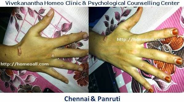  Chennai Specialty Homeopathy Treatment Clinic for Warts, Genital Warts, Velachery, Chennai, Tamil nadu, India, dr.sendhil kumar, panruti